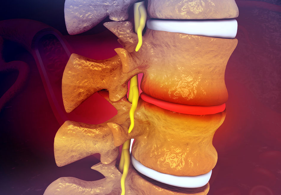 Spine showing thinning disc causing pain